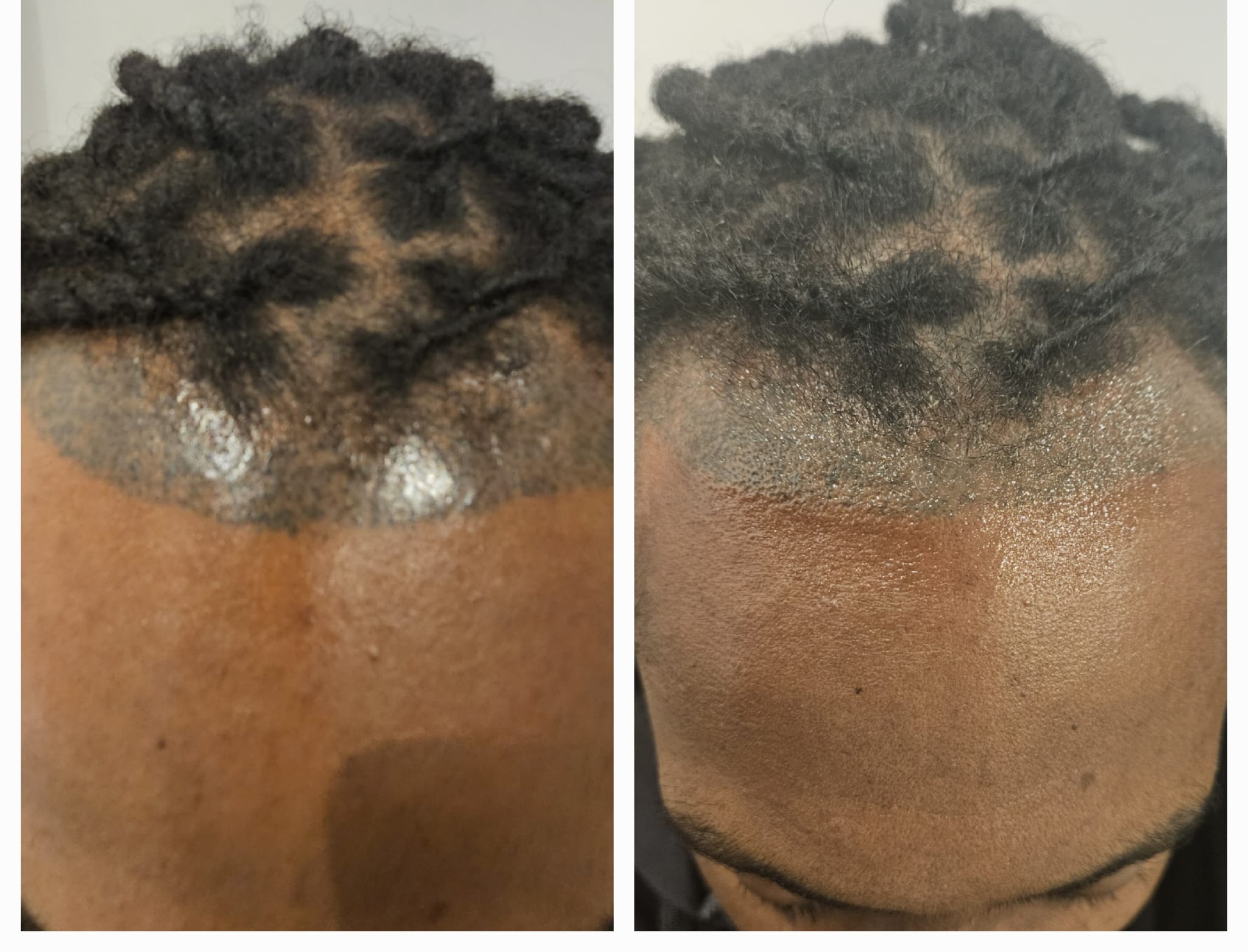 Laser tattoo removal performed safely on darker skin at Rico Clinic, Montreal