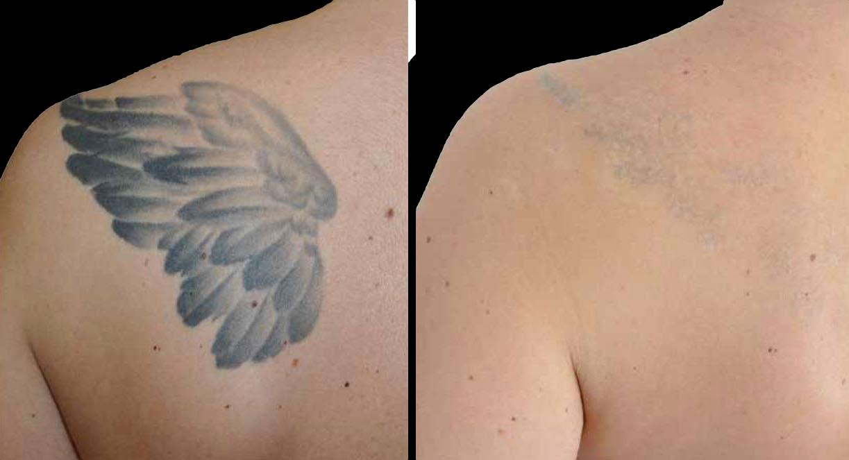 Close-up of a laser tattoo removal treatment on a client's skin at Rico Clinic