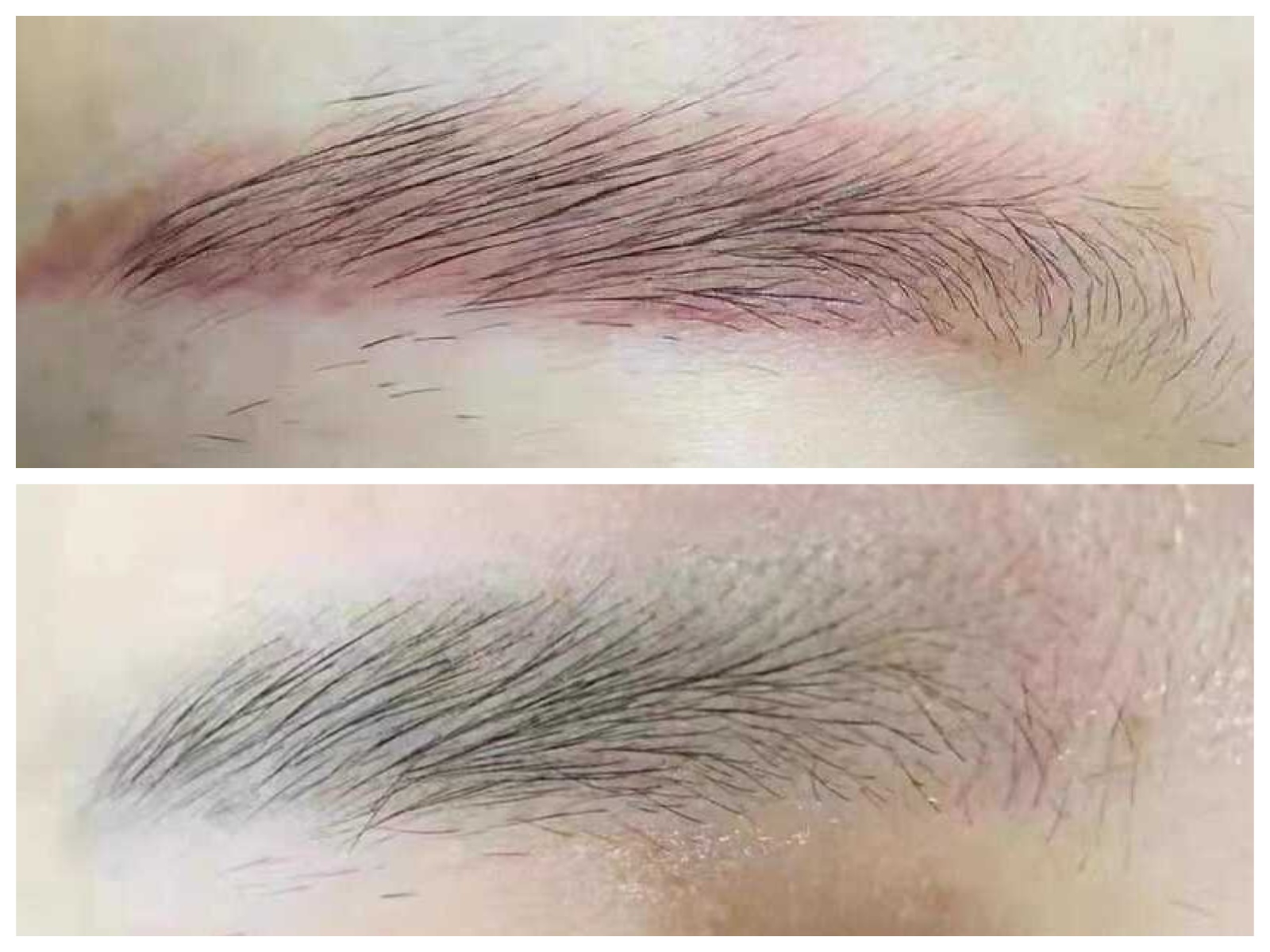 Laser removal of permanent makeup at Rico Clinic, Montreal