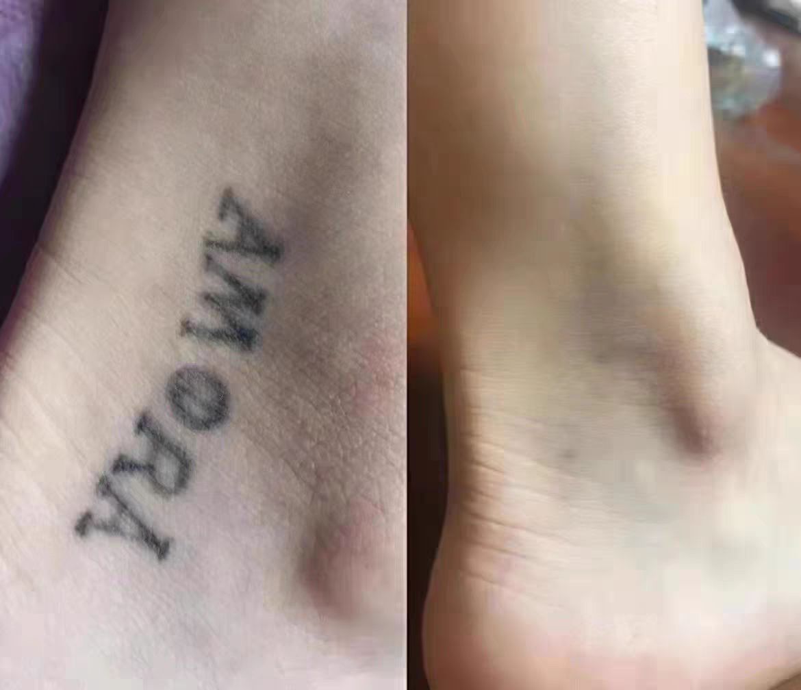 A fading tattoo partway through a course of laser removal at Rico Clinic