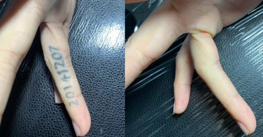 tattoo removal before and after rico clinic