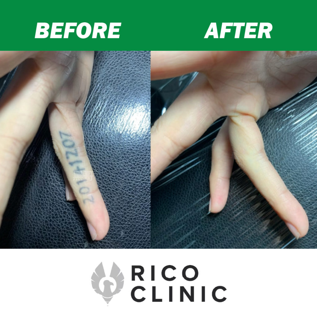 détatouage avant et après clinique rico