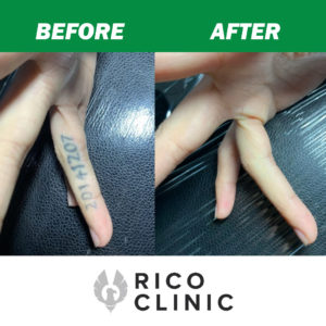 tattoo removal before and after rico clinic