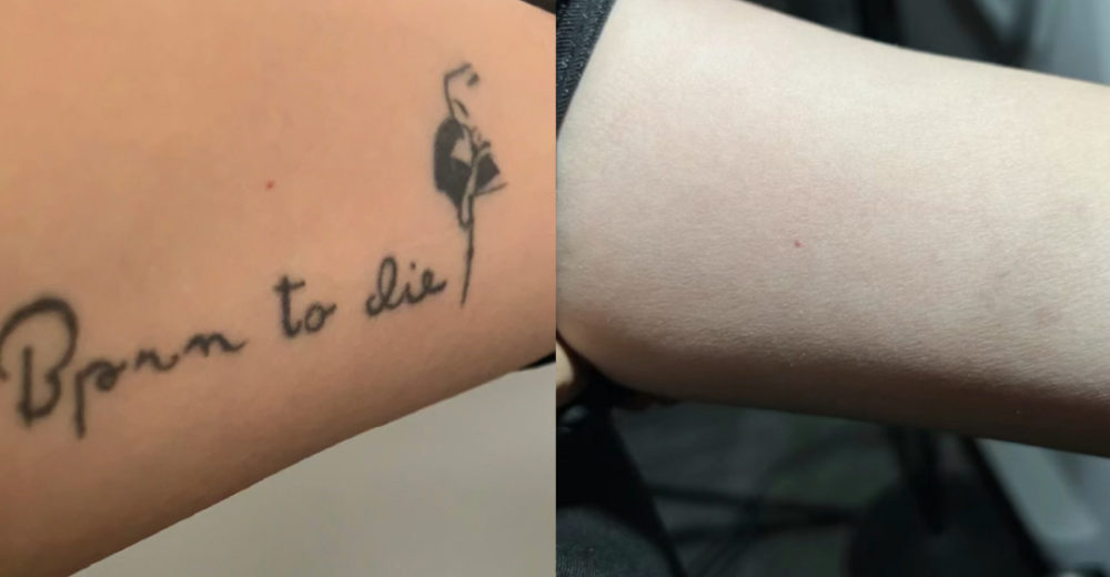 tattoo removal before and after rico clinic