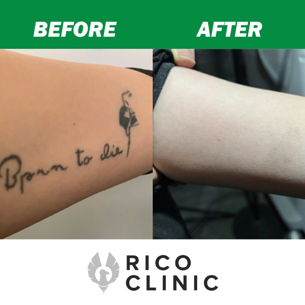 détatouage avant et après clinique rico