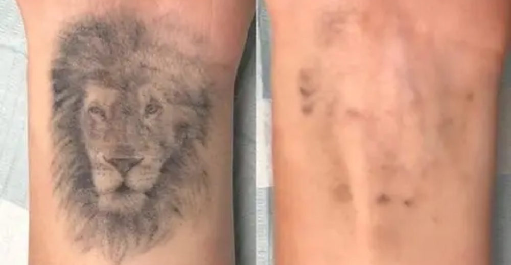 rico clinic tattoo removal results