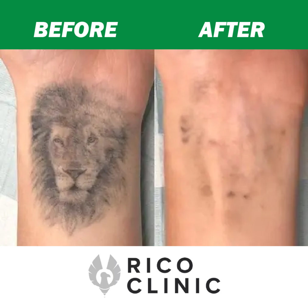 rico clinic tattoo removal results