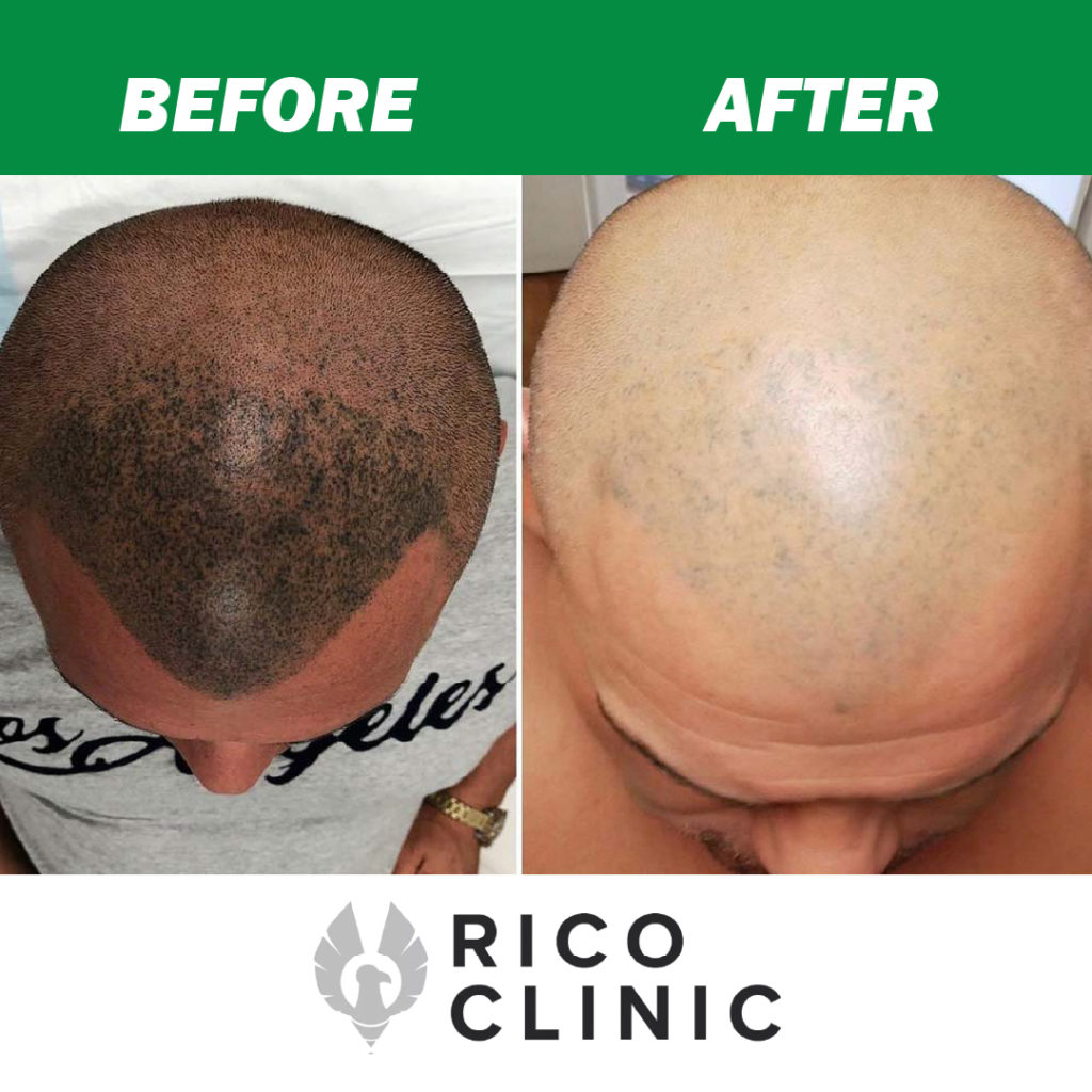 rico clinic suppression de la micropigmentation