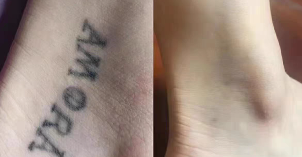 rico clinic tattoo removal