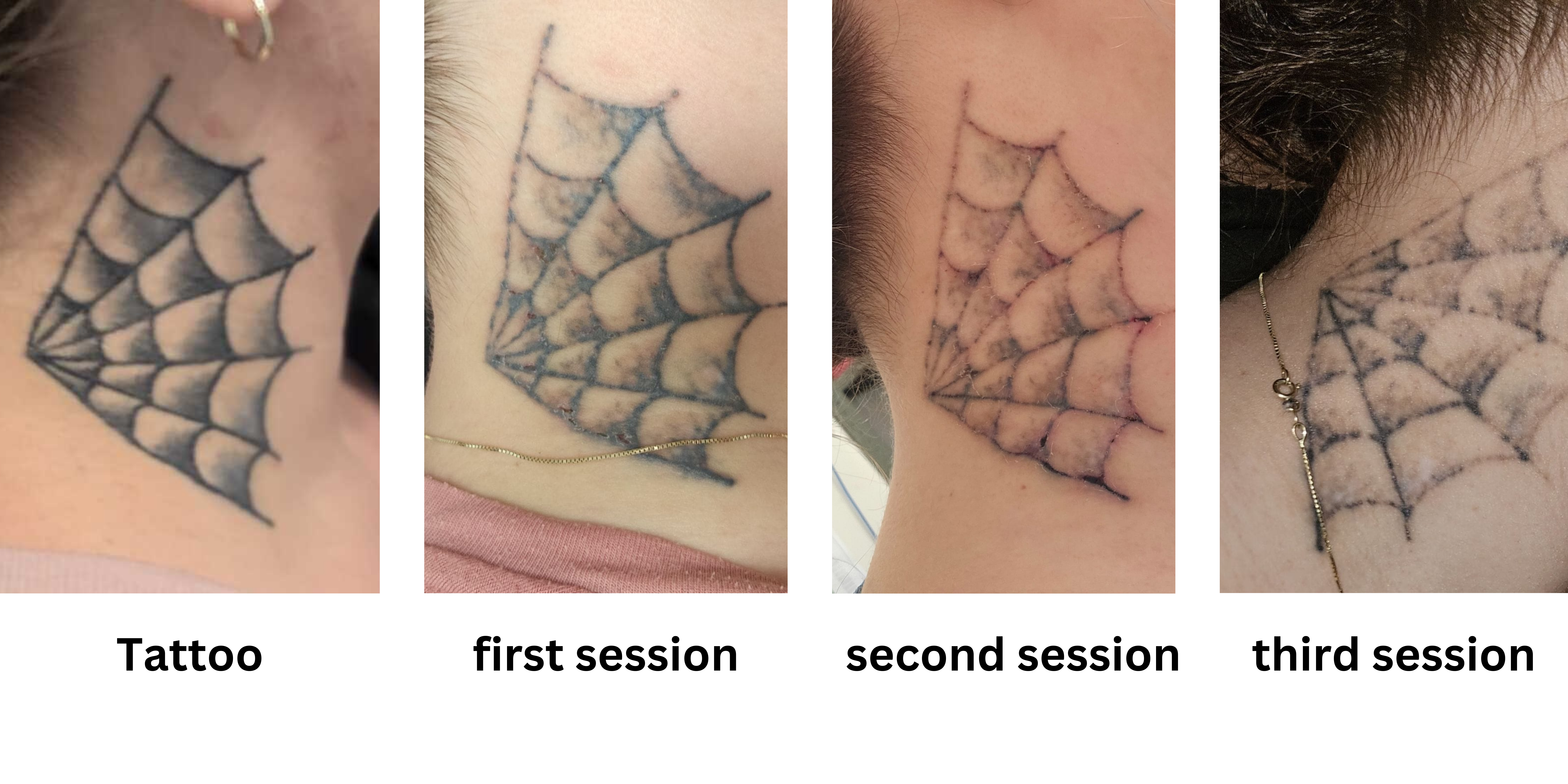 A tattoo being targeted during a laser removal session at Rico Clinic, Montreal
