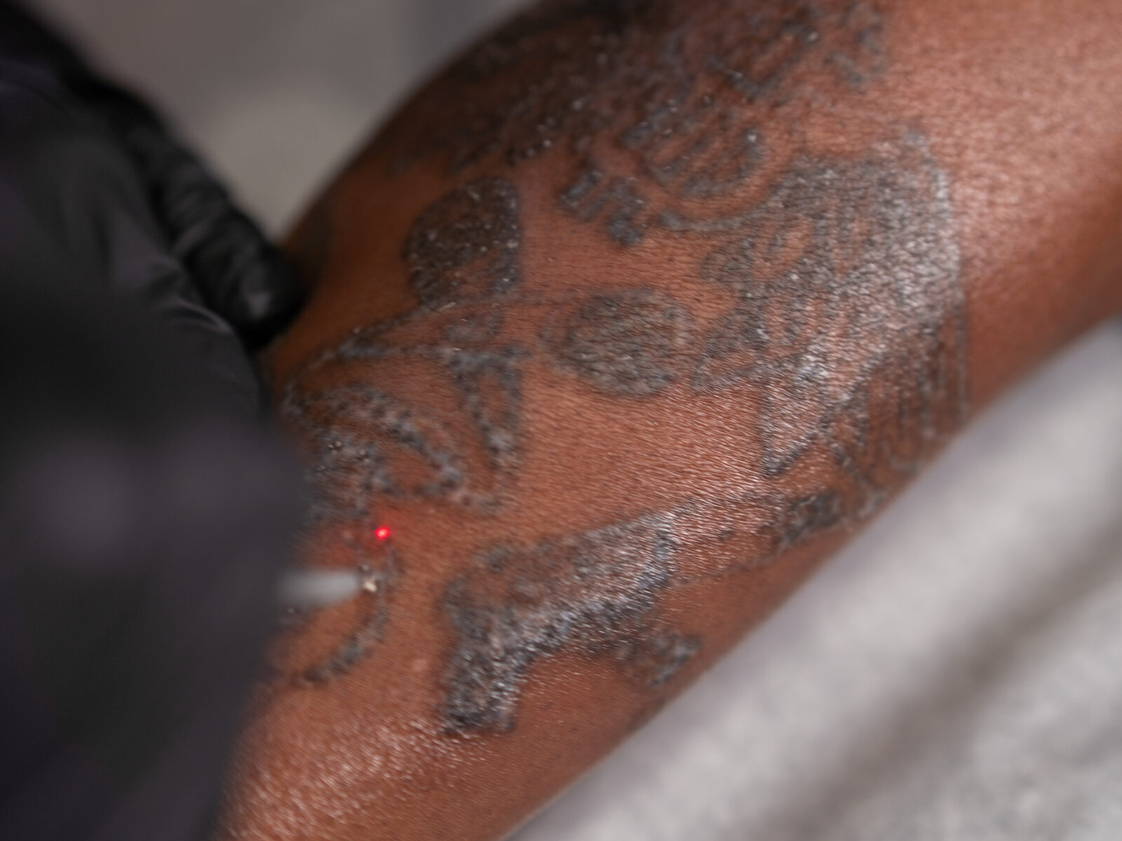 Rico Clinic, Montreal — laser tattoo removal faded result montreal
