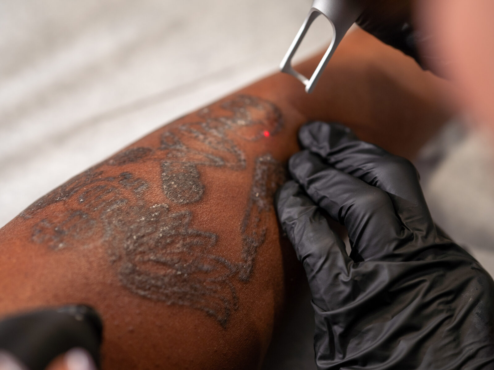 Close-up of a strongly faded tattoo during laser removal at Rico Clinic