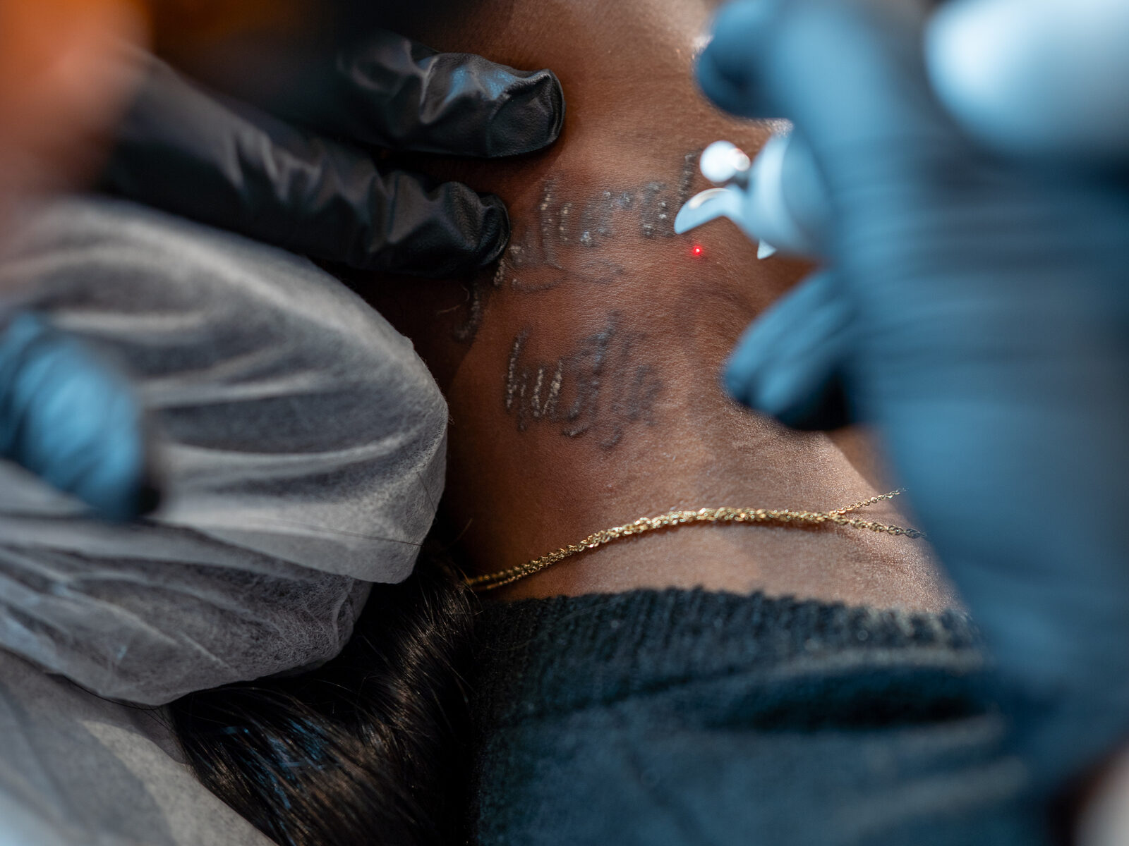 Laser tattoo removal on a client's torso at Rico Clinic, Montreal
