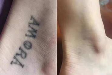 rico clinic tattoo removal