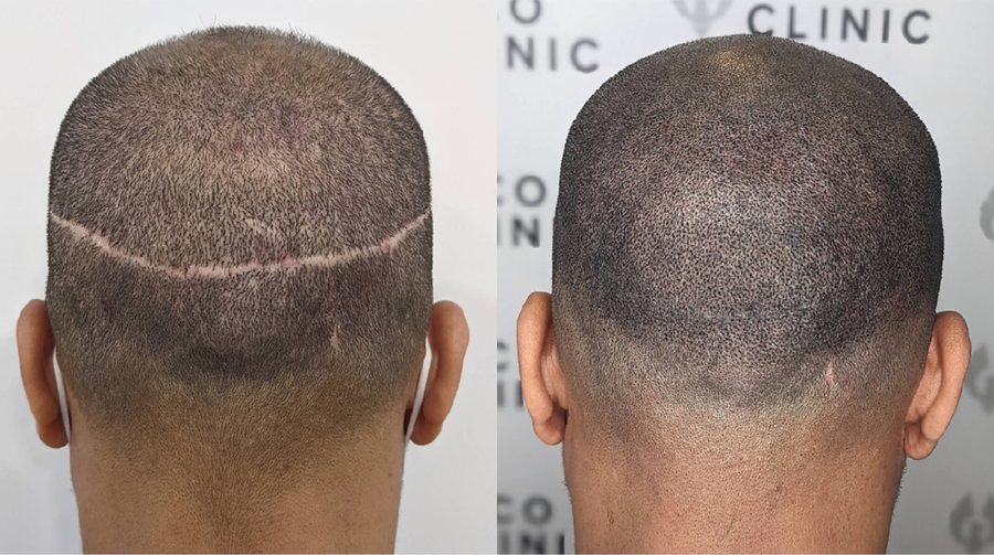SMP removal and scar camouflage before and after at Rico Clinic, Montreal