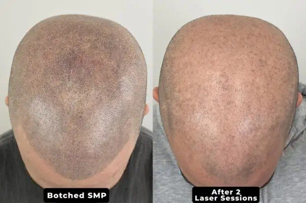 SMP removal and scar camouflage before and after at Rico Clinic, Montreal