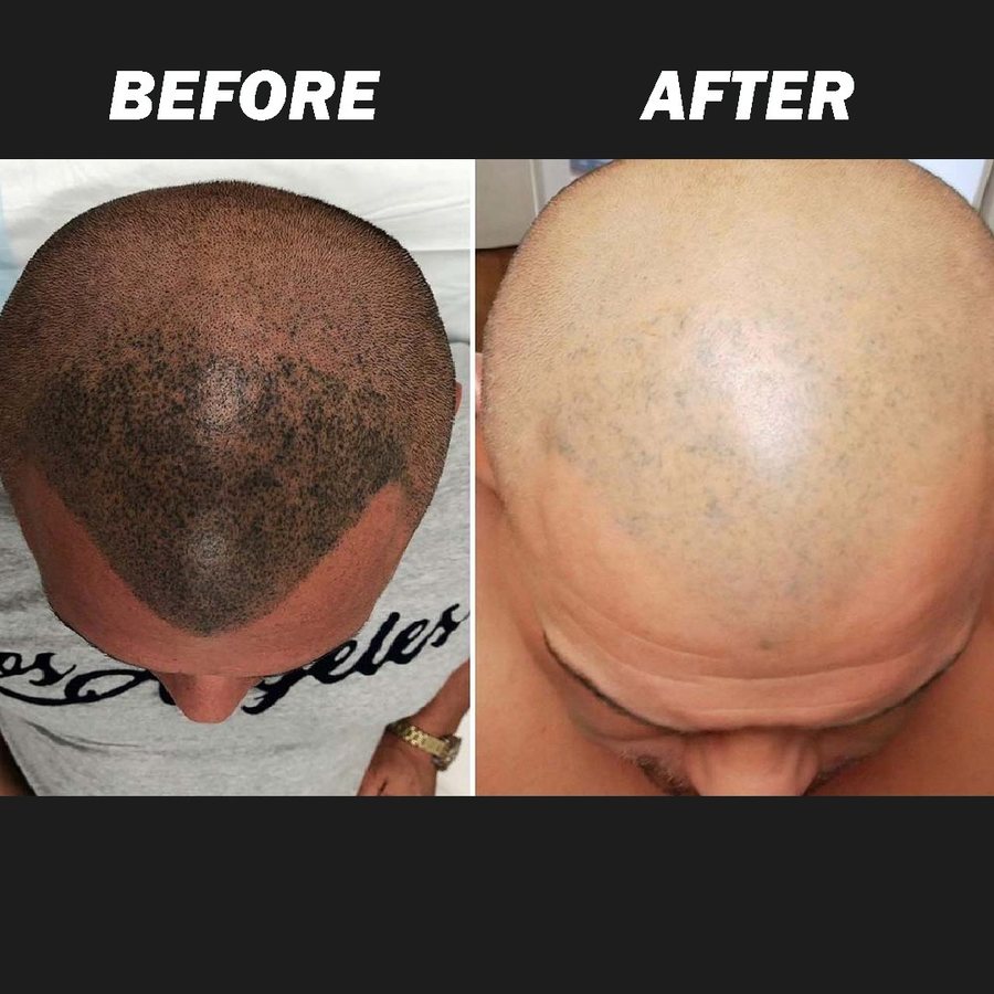 SMP removal and scar camouflage before and after at Rico Clinic, Montreal
