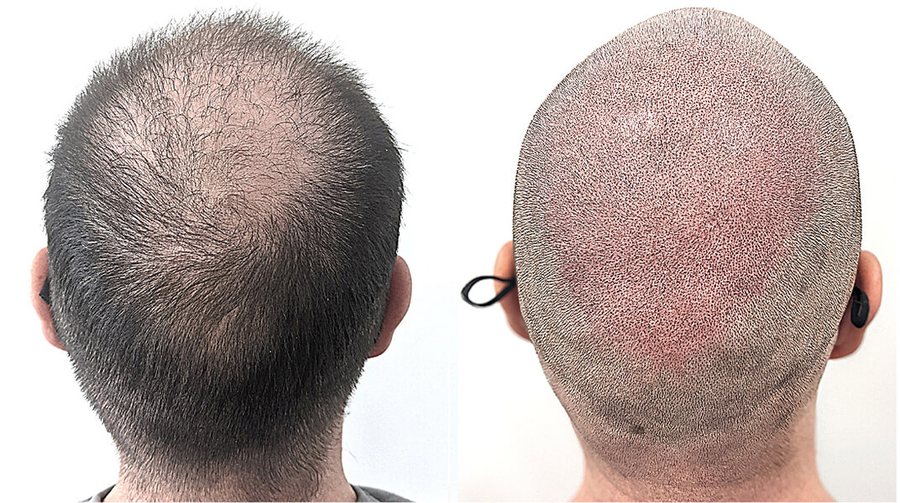 Scalp micropigmentation before and after result at Rico Clinic, Montreal