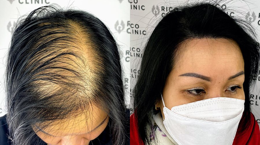 Scalp micropigmentation before and after result at Rico Clinic, Montreal
