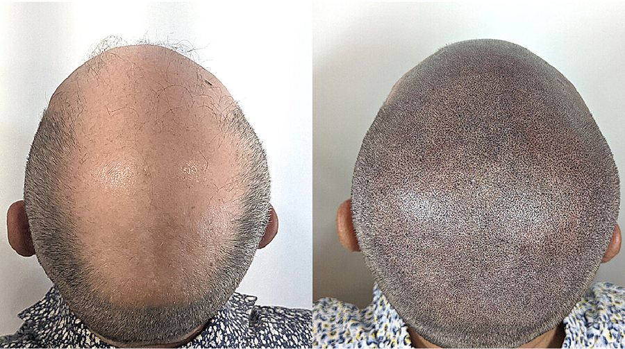 Scalp micropigmentation before and after result at Rico Clinic, Montreal