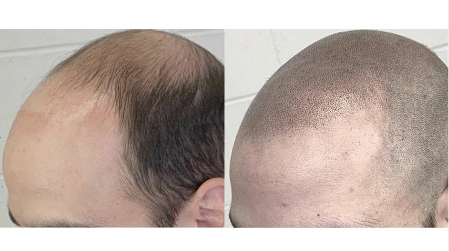 Scalp micropigmentation before and after result at Rico Clinic, Montreal