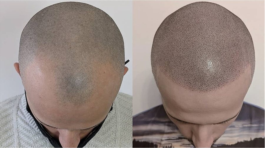 Scalp micropigmentation before and after result at Rico Clinic, Montreal