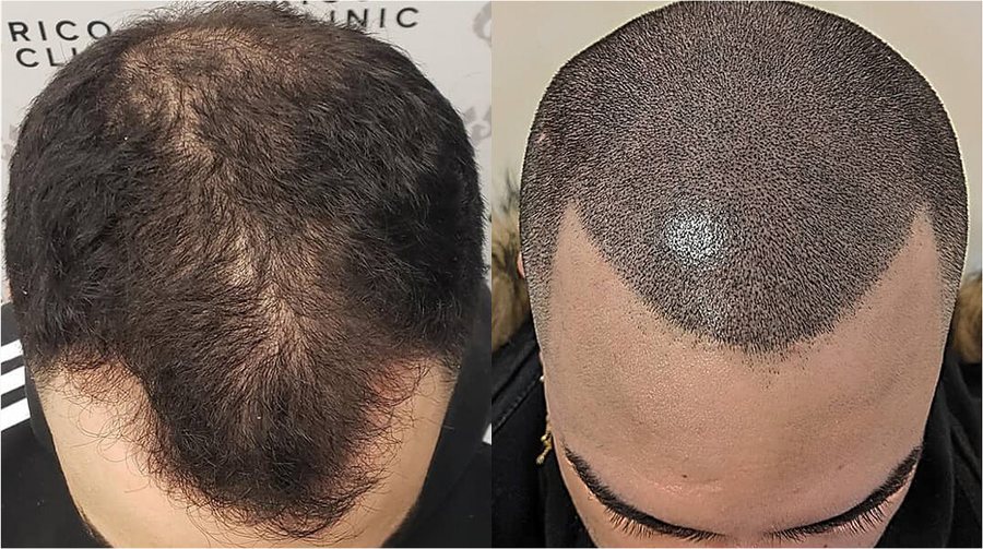 Scalp micropigmentation before and after result at Rico Clinic, Montreal