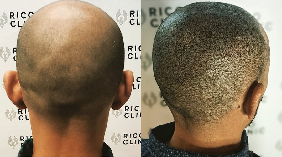 Scalp micropigmentation before and after result at Rico Clinic, Montreal