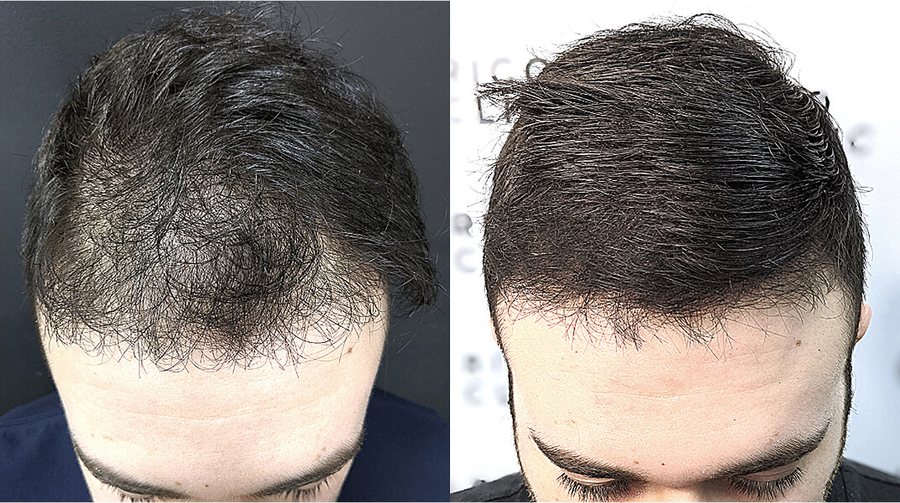 Scalp micropigmentation before and after result at Rico Clinic, Montreal