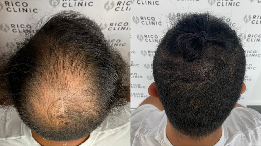 Scalp micropigmentation before and after result at Rico Clinic, Montreal