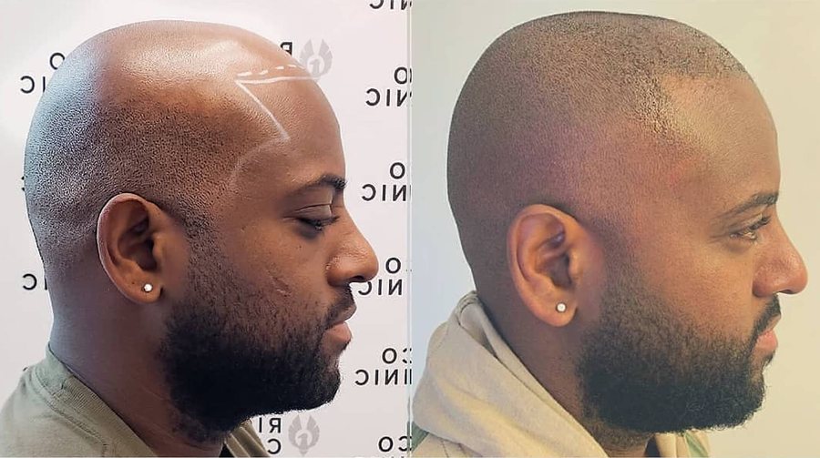 Scalp micropigmentation before and after result at Rico Clinic, Montreal