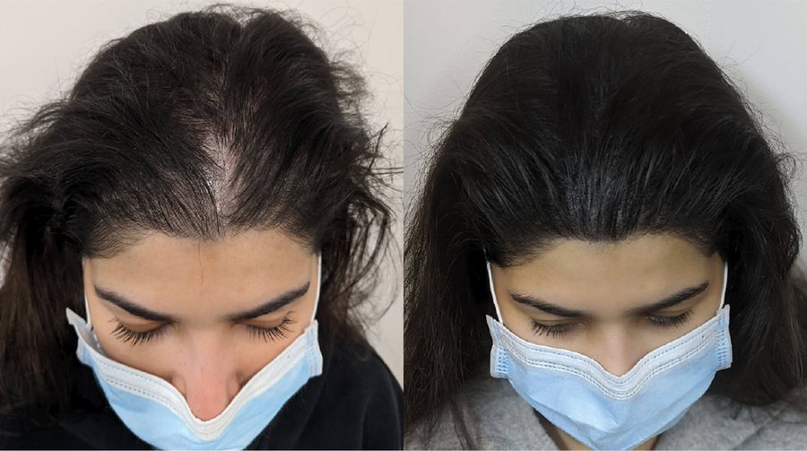 Scalp micropigmentation before and after result at Rico Clinic, Montreal