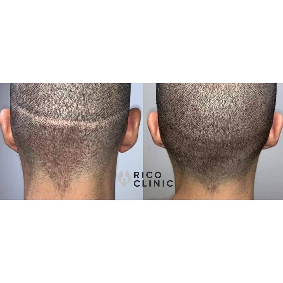 Scalp micropigmentation before and after result at Rico Clinic, Montreal