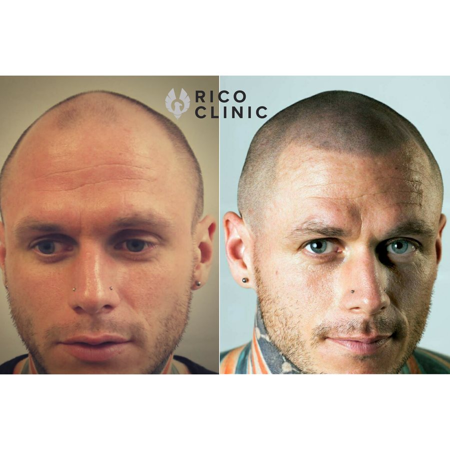Scalp micropigmentation before and after result at Rico Clinic, Montreal