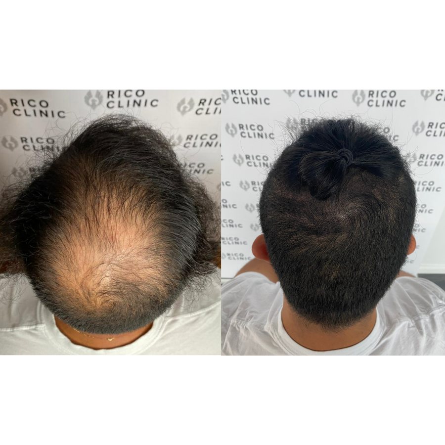 Scalp micropigmentation before and after result at Rico Clinic, Montreal