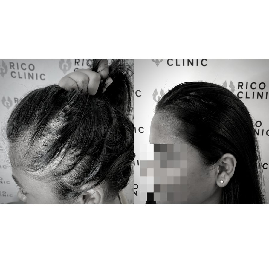 Scalp micropigmentation before and after result at Rico Clinic, Montreal
