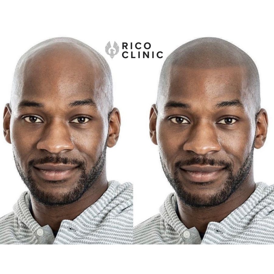 Scalp micropigmentation before and after result at Rico Clinic, Montreal