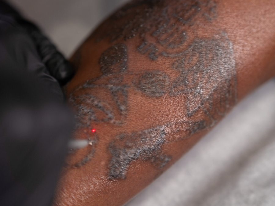 Laser tattoo removal session at Rico Clinic, Montreal