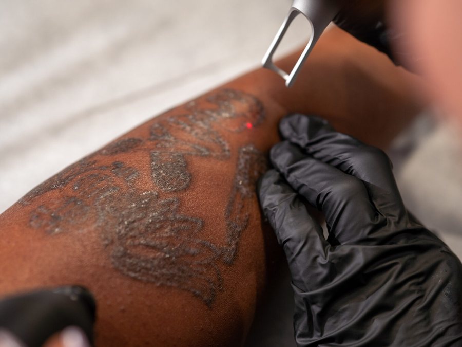 Laser tattoo removal session at Rico Clinic, Montreal
