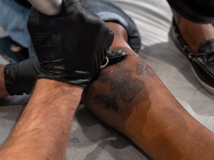 Laser tattoo removal session at Rico Clinic, Montreal