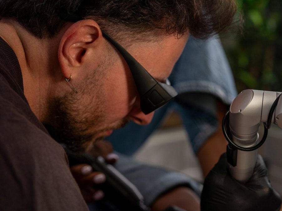 Laser tattoo removal session at Rico Clinic, Montreal