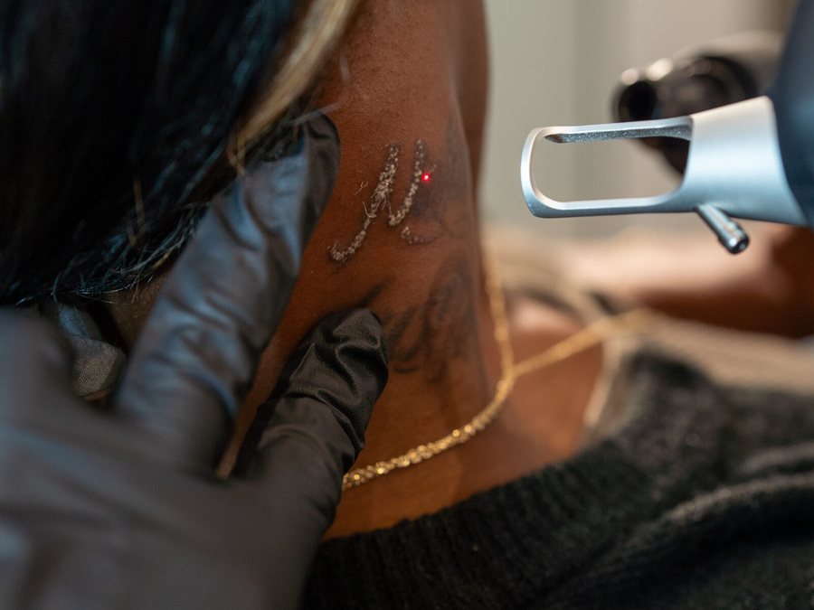 Laser tattoo removal session at Rico Clinic, Montreal