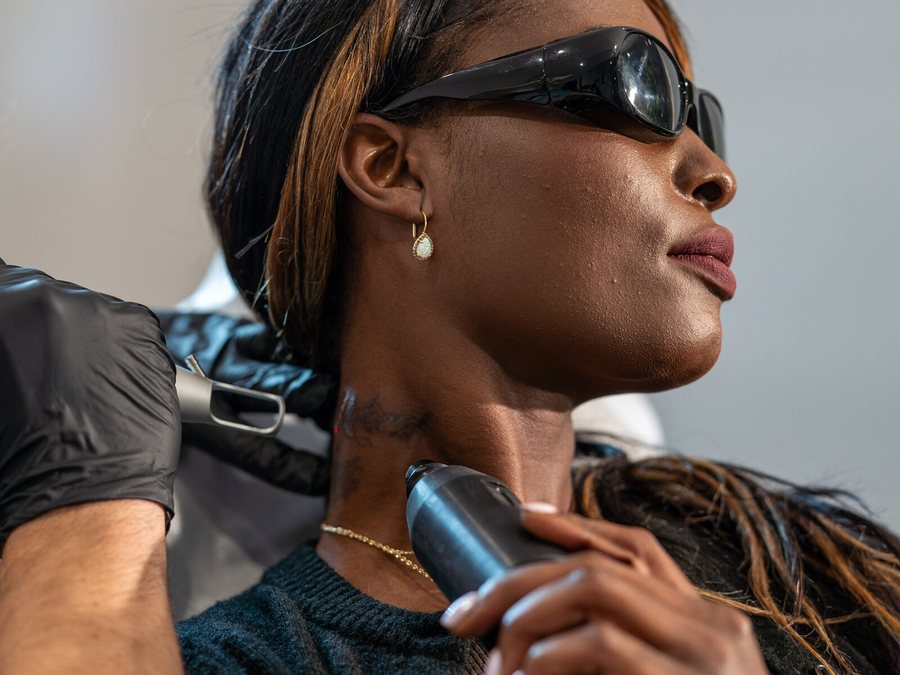 Laser tattoo removal session at Rico Clinic, Montreal