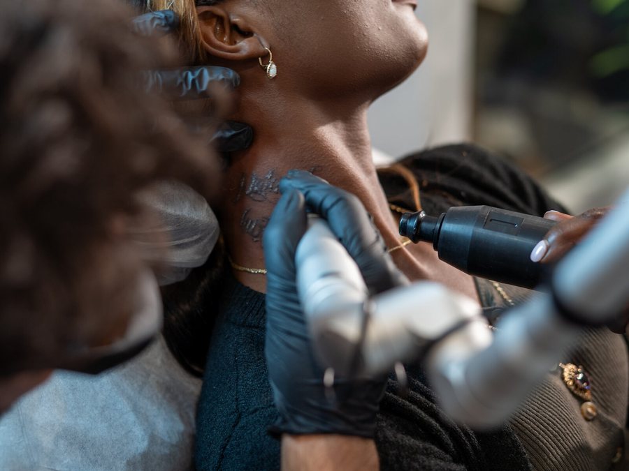 Laser tattoo removal session at Rico Clinic, Montreal