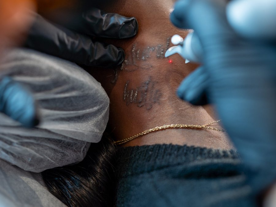 Laser tattoo removal session at Rico Clinic, Montreal
