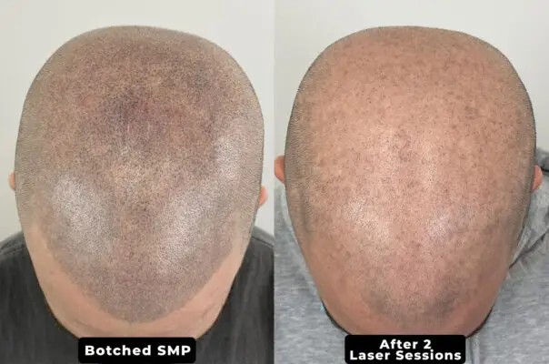 Avant et après : micropigmentation capillaire ratée éclaircie après deux séances de laser pour le retrait de SMP à la Clinique Rico, Montréal